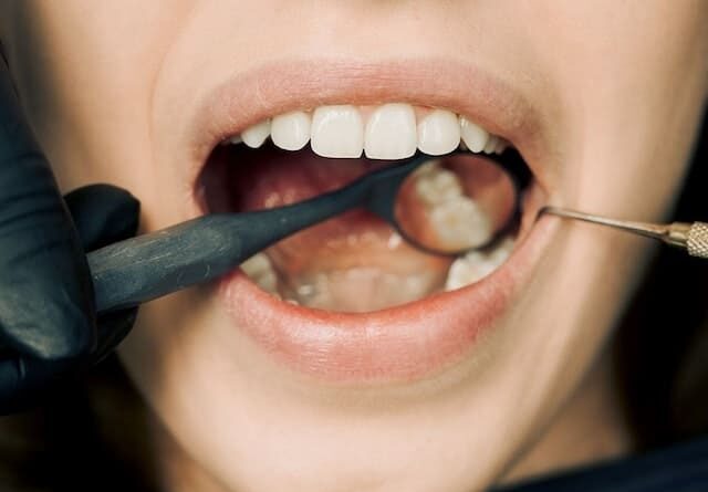 Qual dentista faz limpeza de tártaro: Descubra aqui